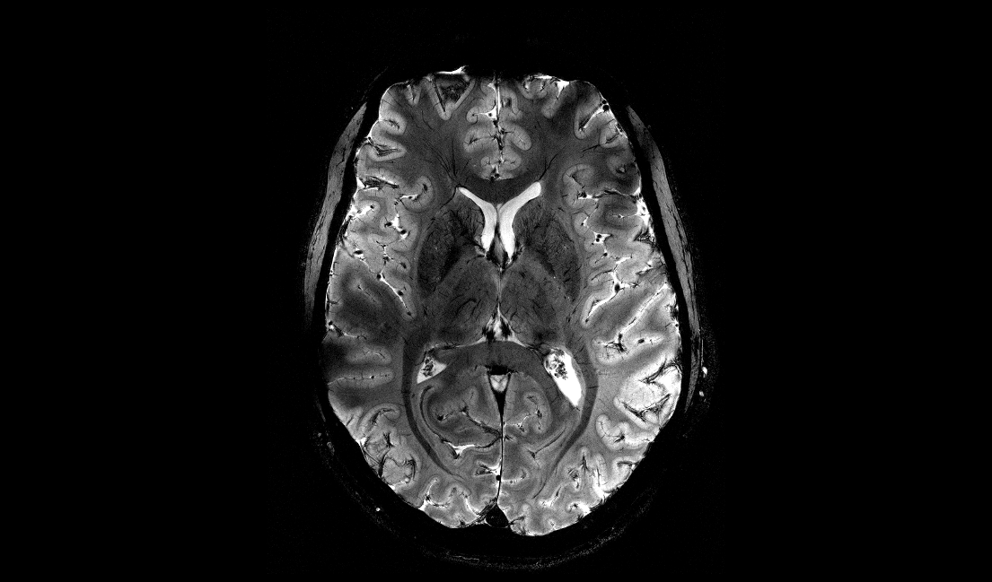 Iseult – Première mondiale : le cerveau dévoilé comme jamais grâce à l’IRM le plus puissant au monde